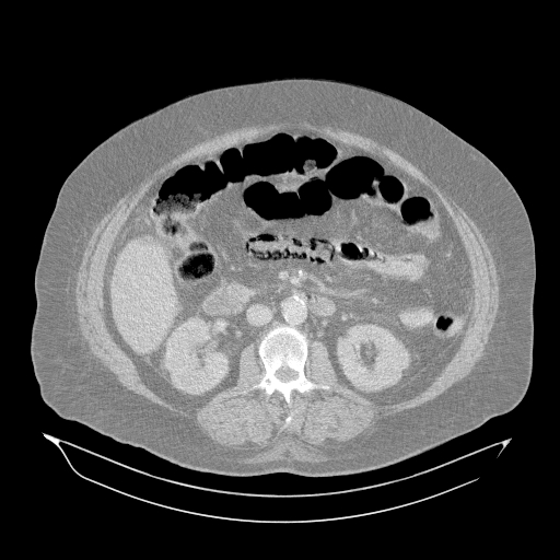 Acute superior mesenteric artery occlusion (Radiopaedia 51288-56960 Axial lung window 25).jpg