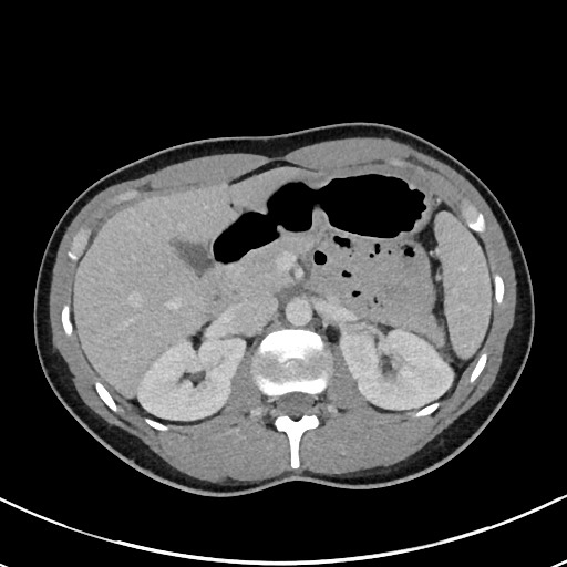 File:Acute uncomplicated appendicitis (Radiopaedia 61374-69304 Axial C+ portal venous phase 36).jpg