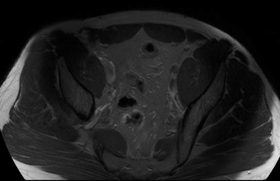 File:Adductor longus tear with retraction (Radiopaedia 56424-63103 Axial T2 fat sat 2).jpg