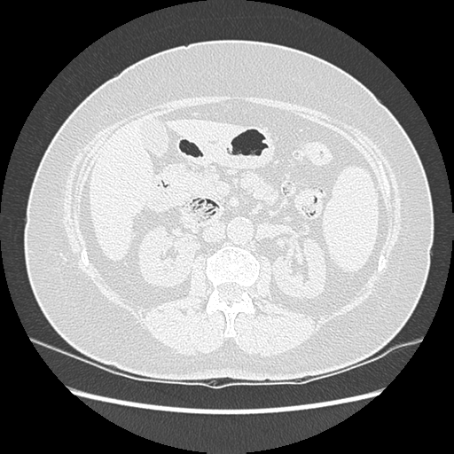 Adenocarcinoma in situ of lung (Radiopaedia 38685-40829 B 251).png