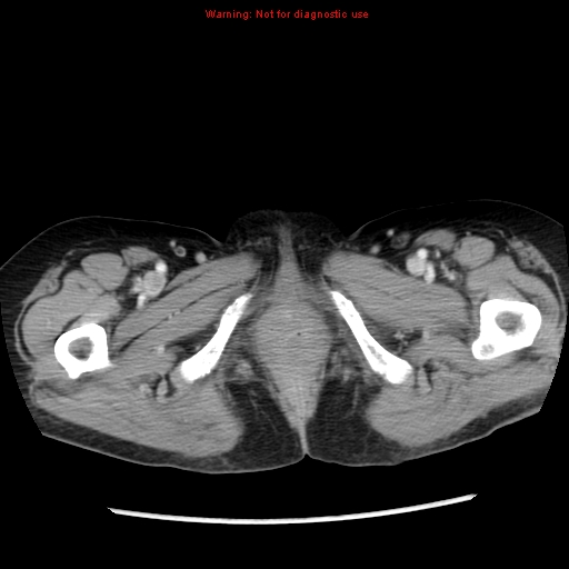 File:Adenocarcinoma of the colon (Radiopaedia 8191-9039 Axial liver window 81).jpg