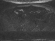 Adenocarcioma of rectum- T1 lesion (Radiopaedia 36921-38546 Axial DWI 51).png