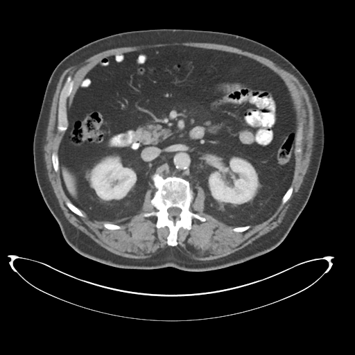 Adenocarcioma of rectum- T1 lesion (Radiopaedia 36921-38547 Axial C+ portal venous phase 34).png