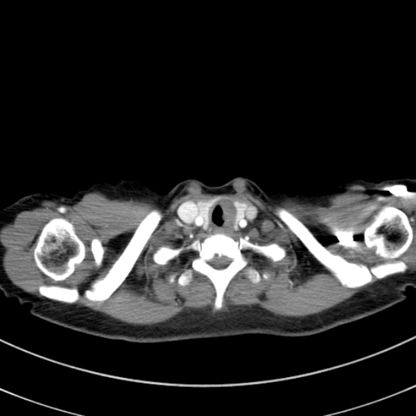 Adenocystic carcinoma of the trachea (Radiopaedia 47677-52525 Axial C+ arterial phase 28).jpg