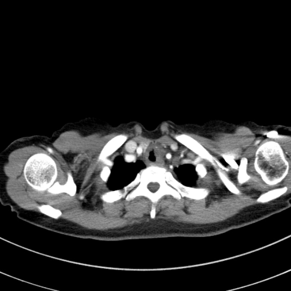 Adenocystic carcinoma of the trachea (Radiopaedia 47677-52525 Axial C+ arterial phase 30).jpg