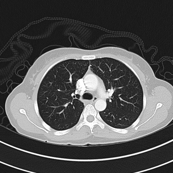 Adenocystic carcinoma of the trachea (Radiopaedia 47677-52525 Axial lung window 45).jpg