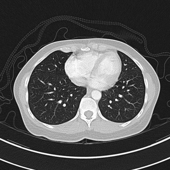 Adenocystic carcinoma of the trachea (Radiopaedia 47677-52525 Axial lung window 65).jpg