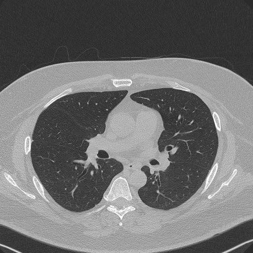 Adenoid cystic carcinoma of the trachea (Radiopaedia 49042-54137 Axial lung window 166).jpg
