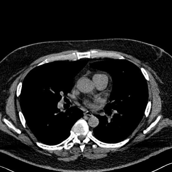 File:Adenoid cystic carcinoma of the trachea (Radiopaedia 49042-54137 Axial non-contrast 178).jpg