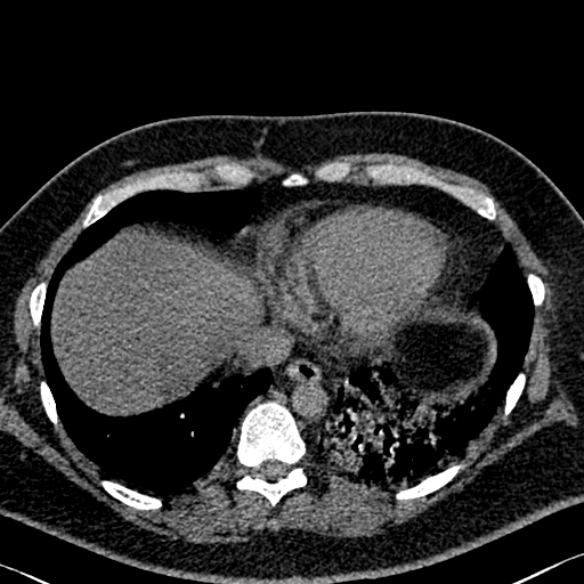 Adenoid cystic carcinoma of the trachea (Radiopaedia 49042-54137 Axial non-contrast 270).jpg