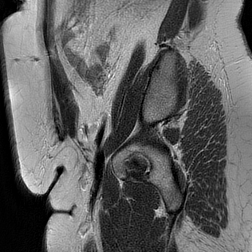 File:Adenomyosis within a didelphys uterus (Radiopaedia 70175-80215 Sagittal T2 4).jpg