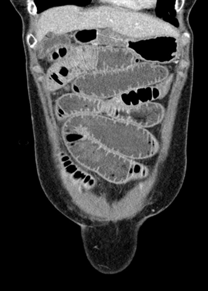 Adhesional small bowel obstruction (Radiopaedia 48397-53305 Coronal C+ portal venous phase 71).jpg