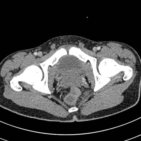 Adhesional small bowel obstruction (Radiopaedia 52107-57980 Axial C+ portal venous phase 124).jpg