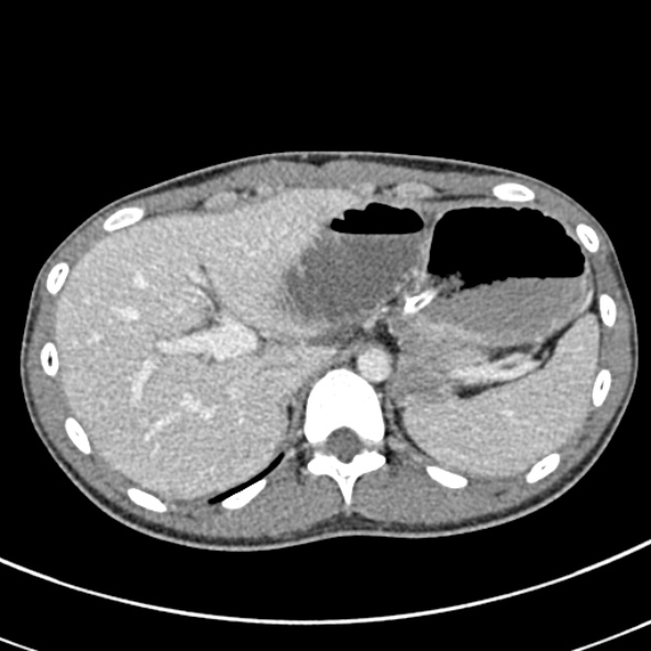 File:Adhesional small bowel obstruction (Radiopaedia 52107-57980 Axial C+ portal venous phase 22).jpg