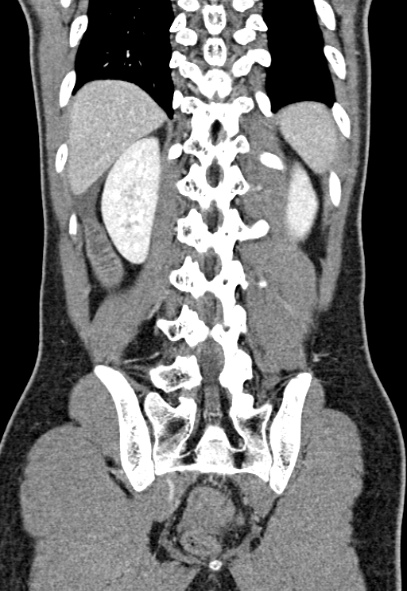 Adhesional small bowel obstruction (Radiopaedia 52107-57980 Coronal C+ portal venous phase 65).jpg