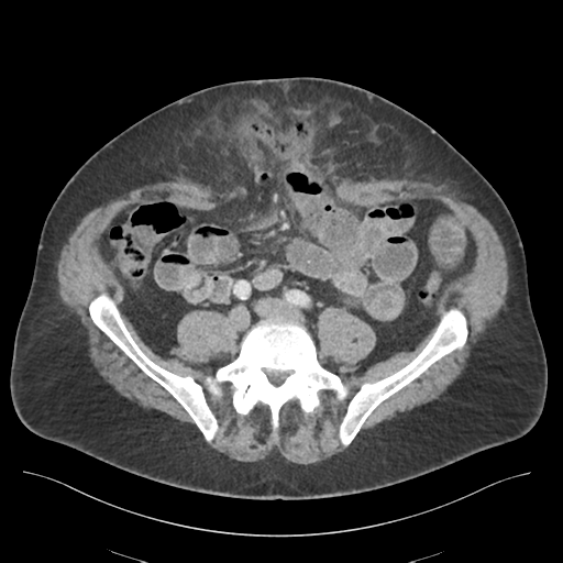 Adhesions within abdominal wall hernia (Radiopaedia 58283-65394 Axial C+ portal venous phase 56).png