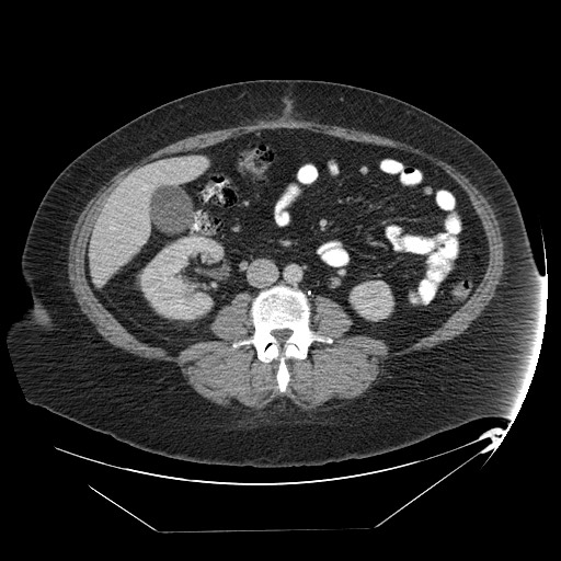 File:Adrenal angiosarcoma (Radiopaedia 81081-94671 Axial C+ portal venous phase 44).jpg
