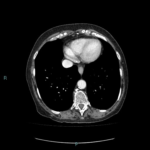 File:Adrenal collision tumor (ACT) (Radiopaedia 48462-53379 Axial C+ portal venous phase 2).jpg