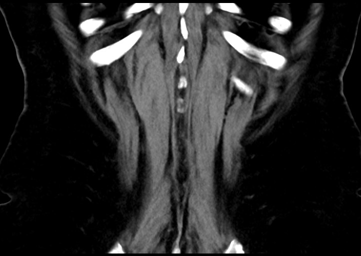 File:Adrenal cortical carcinoma (Radiopaedia 64017-72769 Coronal C+ portal venous phase 49).jpg