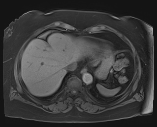 Adrenal cortical carcinoma (Radiopaedia 64017-72770 Axial T1 fat sat 5).jpg