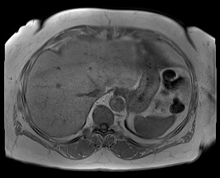 File:Adrenal cortical carcinoma (Radiopaedia 64017-72770 Axial T1 in-phase 9).jpg