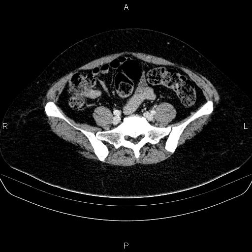 Adrenal cortical carcinoma (Radiopaedia 84882-100379 Axial C+ portal venous phase 68).jpg