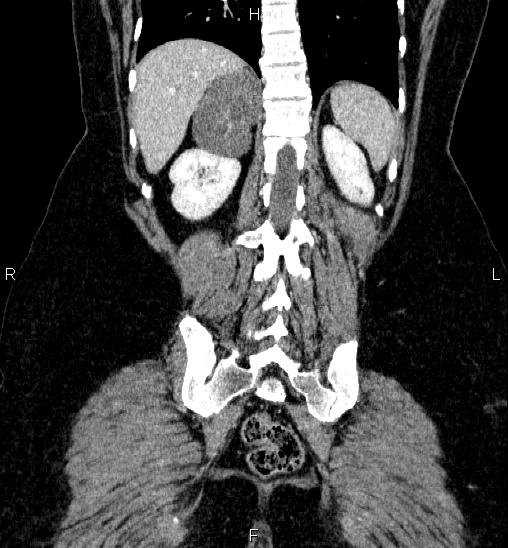 Adrenal cortical carcinoma (Radiopaedia 84882-100379 Coronal C+ portal venous phase 50).jpg