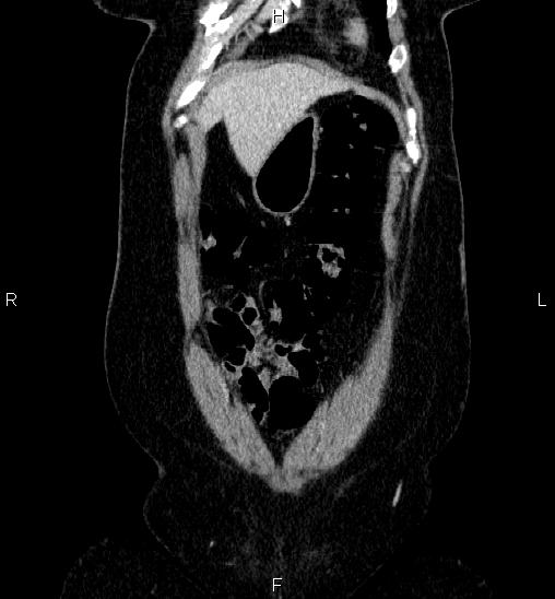 Adrenal cortical carcinoma (Radiopaedia 84882-100379 Coronal C+ portal venous phase 7).jpg