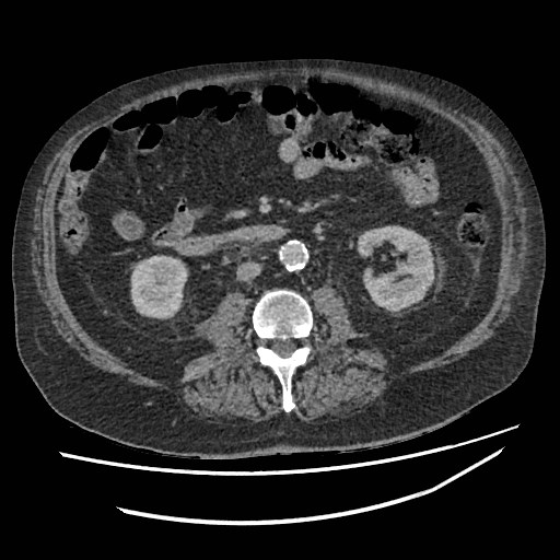 Adrenal lymphoma (Radiopaedia 84145-99415 Axial C+ portal venous phase 71).jpg