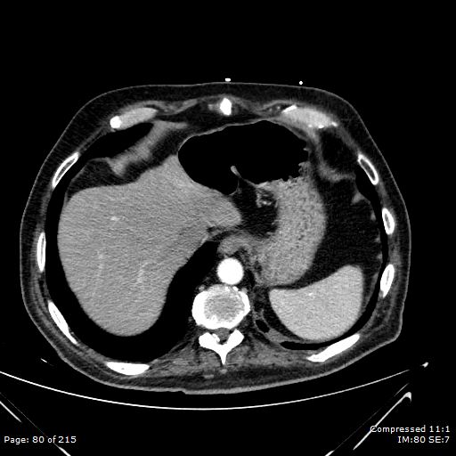 Adrenal metastasis (Radiopaedia 78425-91079 Axial C+ arterial phase 10).jpg
