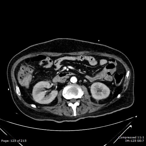Adrenal metastasis (Radiopaedia 78425-91079 Axial C+ arterial phase 55).jpg