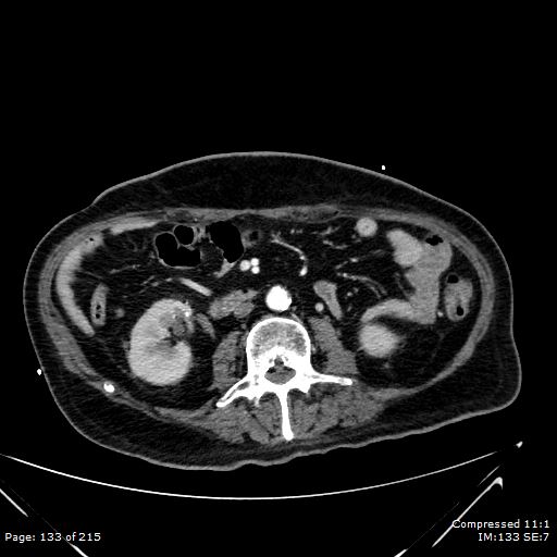 Adrenal metastasis (Radiopaedia 78425-91079 Axial C+ arterial phase 63).jpg