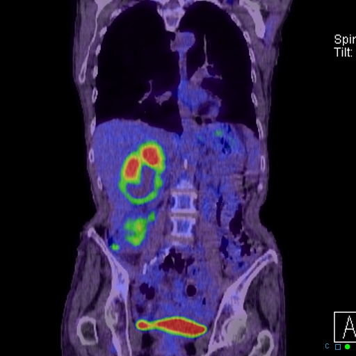File:Adrenal metastasis from small cell lung cancer (Radiopaedia 19133-19109 Coronal 16).jpg