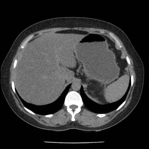 Adrenal myelolipoma (Radiopaedia 43401-46759 Axial non-contrast 18).jpg