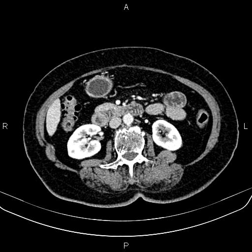 Adrenal myelolipoma (Radiopaedia 82742-96986 Axial renal cortical phase 83).jpg