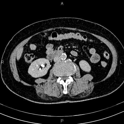 Adrenal myelolipoma (Radiopaedia 82742-96986 Axial renal excretory phase 77).jpg