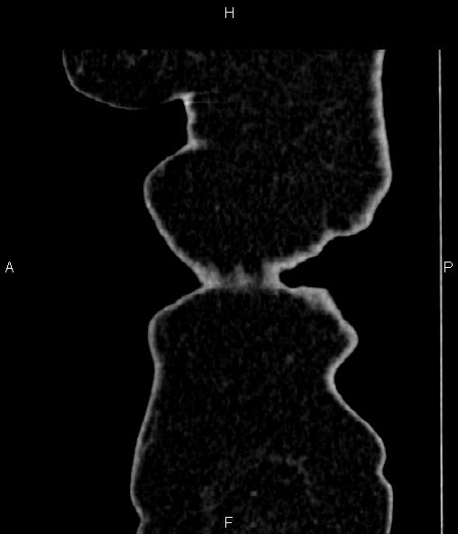 Adrenal myelolipoma (Radiopaedia 82742-96986 Sagittal renal cortical phase 109).jpg