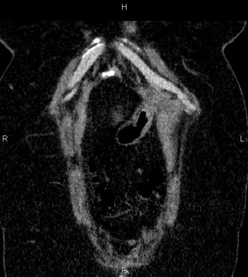 Adrenal myelolipoma (Radiopaedia 84319-99617 Coronal renal cortical phase 5).jpg
