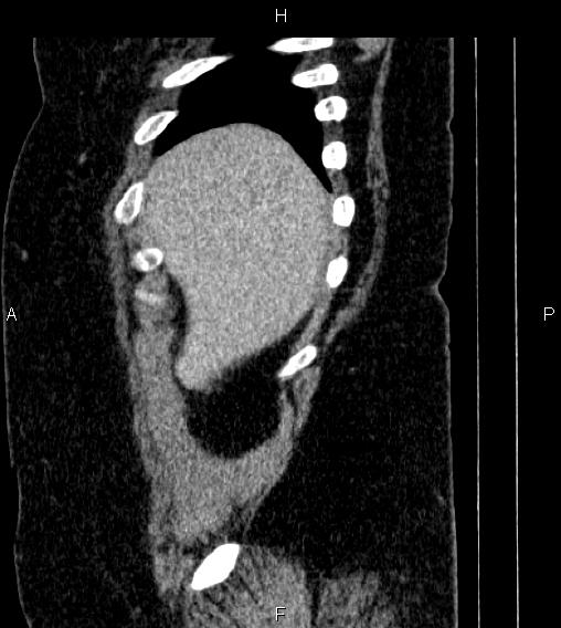 Adrenal myelolipoma (Radiopaedia 84319-99617 Sagittal renal cortical phase 7).jpg