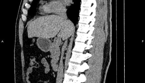 Adrenal myelolipoma (Radiopaedia 84321-99619 Sagittal non-contrast 50).jpg