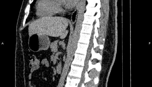 Adrenal myelolipoma (Radiopaedia 84321-99619 Sagittal non-contrast 57).jpg