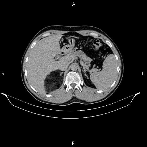 Adrenal myelolipoma (Radiopaedia 87794-104246 Axial renal excretory phase 26).jpg
