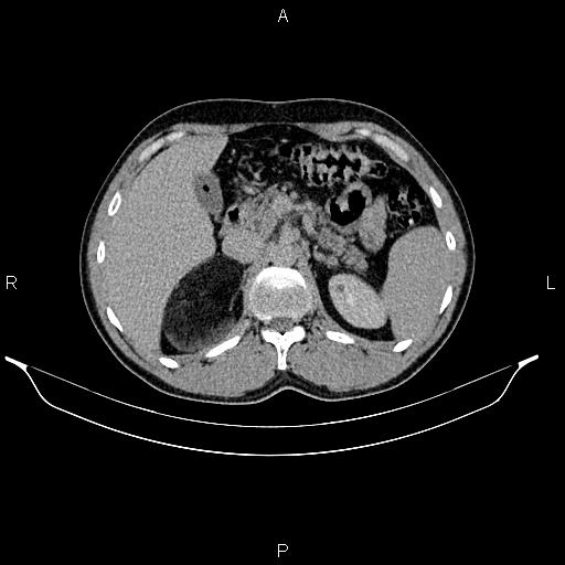 Adrenal myelolipoma (Radiopaedia 87794-104246 Axial renal excretory phase 31).jpg
