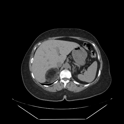 Adrenal myelolipoma - MRI (Radiopaedia 83249-97647 Axial non-contrast 15).jpg