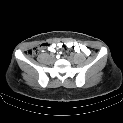 File:Adrenal myelolipoma - bilateral (Radiopaedia 74805-85810 Axial non-contrast 58).jpg