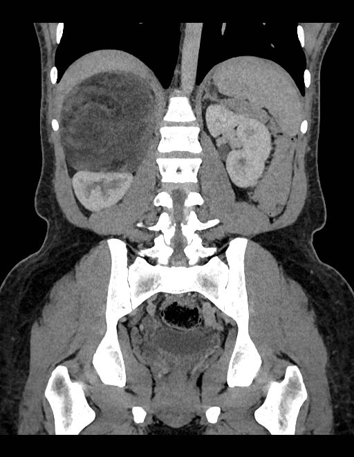 Adrenal myelolipoma - bilateral (Radiopaedia 74805-85810 Coronal C+ portal venous phase 119).jpg