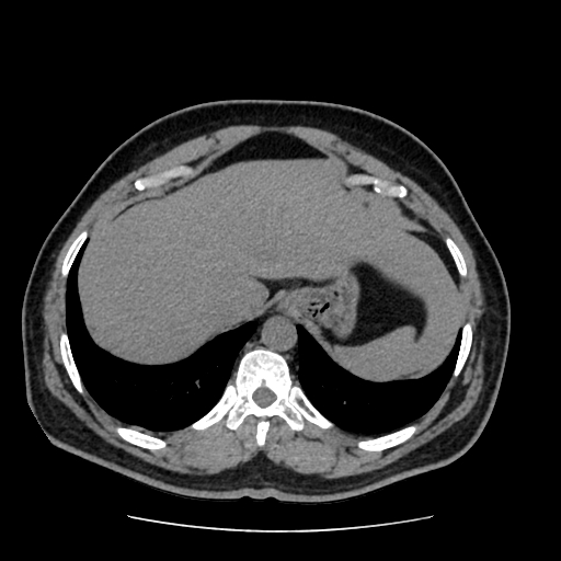 Adrenal myelolipoma and beaver tail liver (Radiopaedia 86201-102193 Axial non-contrast 69).jpg