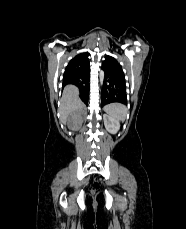 Adrenocortical carcinoma (Radiopaedia 80134-93438 Coronal C+ portal venous phase 127).jpg
