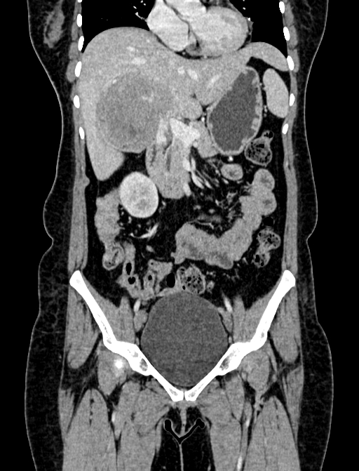 Adrenocortical carcinoma (Radiopaedia 87281-103569 Coronal C+ portal venous phase 23).jpg