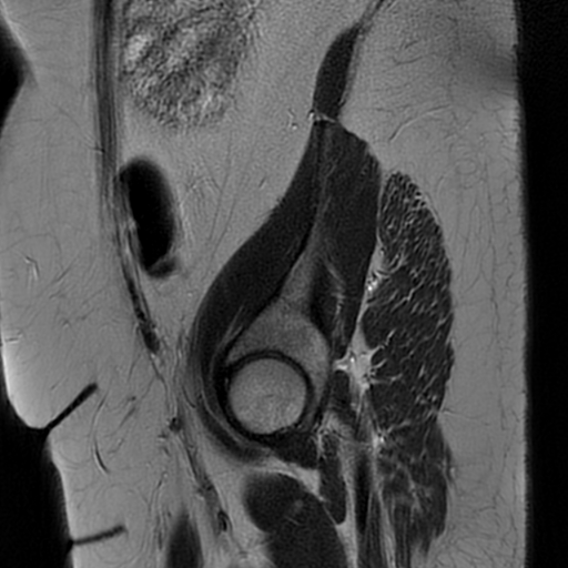File:Adult granulosa cell tumor of the ovary (Radiopaedia 64991-73953 Sagittal T2 27).jpg
